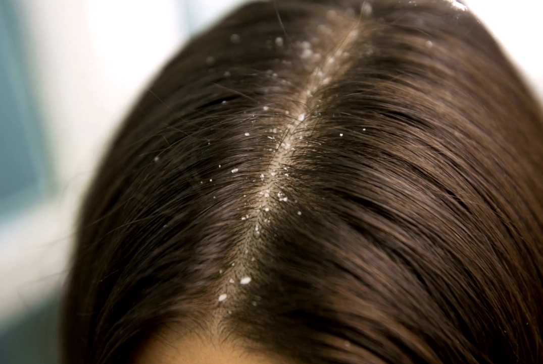 Common Scalp Conditions and Their Impact