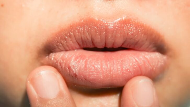 Lip Pimples - How to get rid