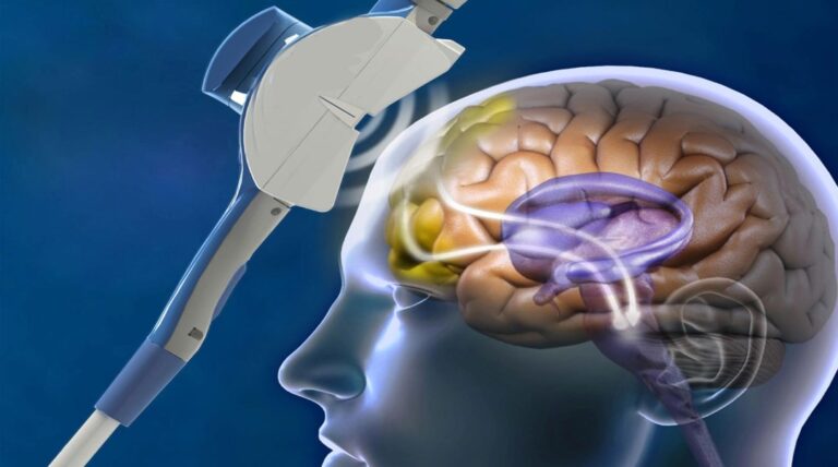 How Does Spravato Therapy Affect the Brain?